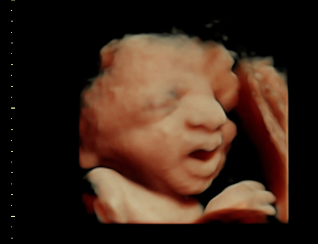 3D ultrasound image at 31 weeks